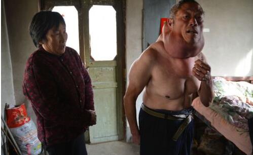山东男子脖子比头大 一家五口全靠儿子打工养活