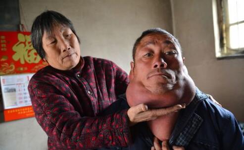 山东男子脖子比头大 一家五口全靠儿子打工养活