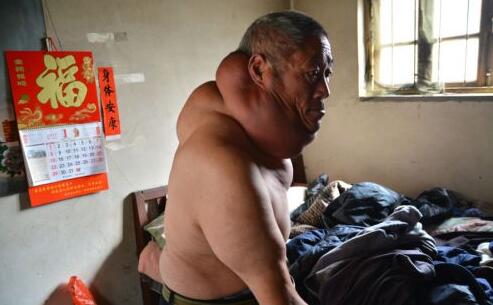 山东男子脖子比头大 一家五口全靠儿子打工养活