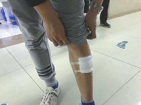 又见狗咬人！为护幼女父亲腿被咬伤 事发广场禁止遛狗