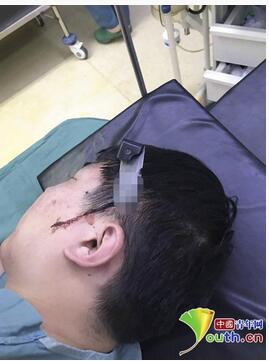 山东文登整骨医院医生被病人捅伤头颈部 刀尖贯穿整个皮下