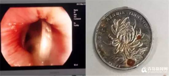 青岛2岁男童误吞1元硬币 小物品千万不要随手乱丢