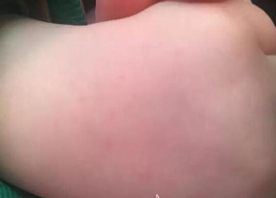 网曝临沂女童被幼儿园老师用针连轧 华大幼儿园未回应