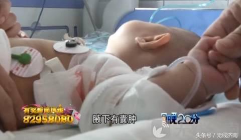 济南四个月男孩得淋巴结核 家长质疑与卡介疫苗有关