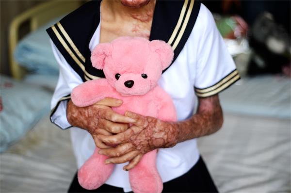 济南:美女高中生90%烧伤 鼓足勇气拍公益写真