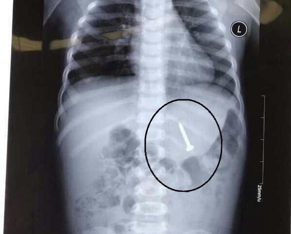 聊城2岁男童一夜哭闹不止 医生从其腹中取出3.3厘米钢钉