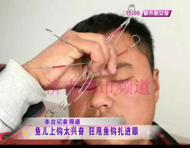 济南两市民小清河钓鱼 鱼钩子甩进眼睛里勾住了眼球