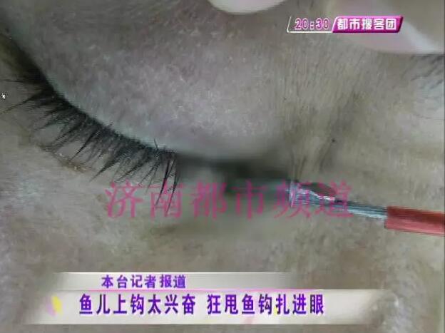 济南两市民小清河钓鱼 鱼钩子甩进眼睛里勾住了眼球