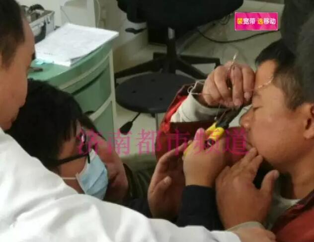 济南两市民小清河钓鱼 鱼钩子甩进眼睛里勾住了眼球