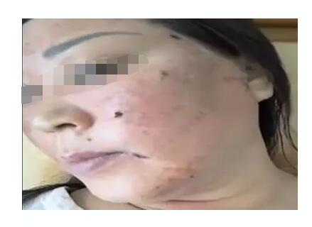 山东日照女子用斑美拉化妆品美容变毁容 重金打水漂