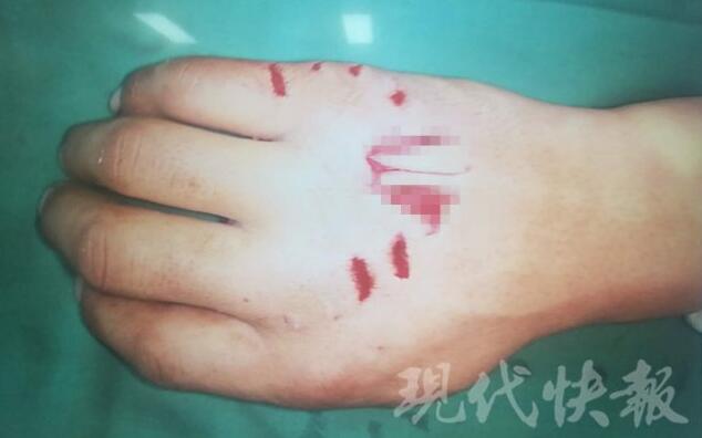 “萌宠”变“猛宠”！宠物鳄鱼击袭主人致手背撕裂惨不忍睹