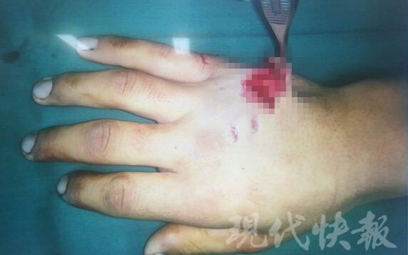 “萌宠”变“猛宠”！宠物鳄鱼击袭主人致手背撕裂惨不忍睹