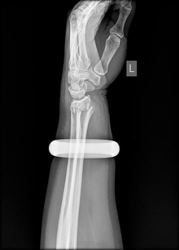 艰难的选择!砸2万玉镯保手臂 女子痛下决心签字为证