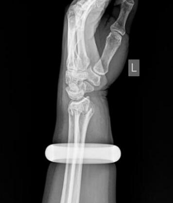 砸2万玉镯保手臂 玉镯深陷肉里,最后怎么解决呢?