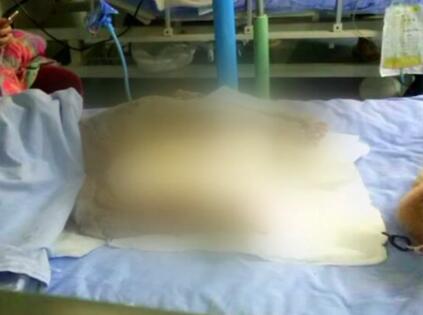 心疼!4岁女童双腿烧焦恐截肢 疑因插线板短路致沙发着火