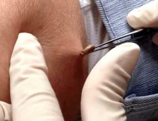 男子野外露营腰部奇痒难忍，对着镜子一照，竟然有东西