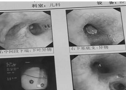 半年不化奶茶珍珠 男童咳嗽半年肺里竟然藏匿着一颗“珍珠”!