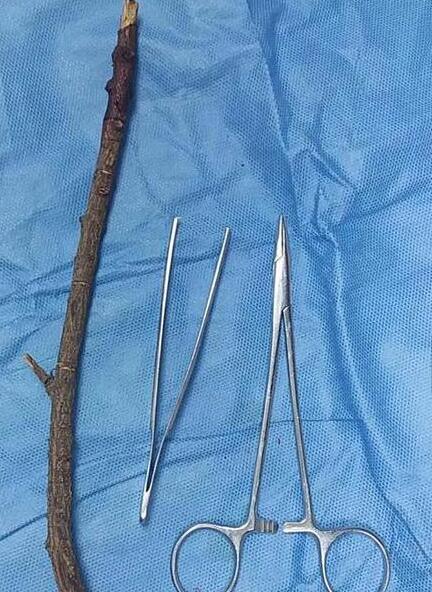 乐极生悲!男子树枝戳穿鼻孔 春节贪杯四小时跑多家医院未果