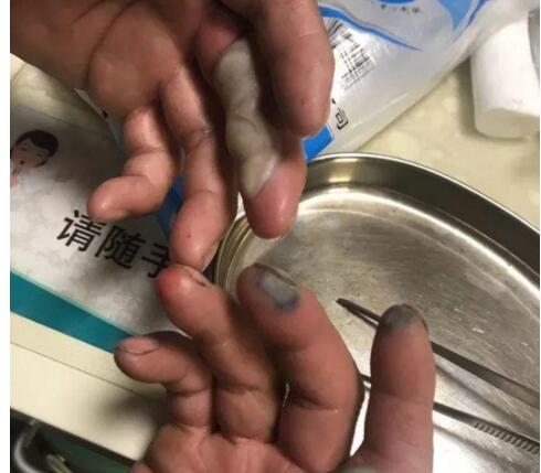 ��Ŀ���ģ�������˫�ֱ���ʴ ���ֶ����ָ����������ָƤ������