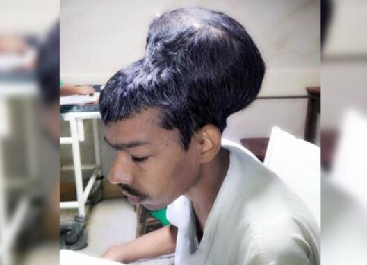 世界最大脑瘤被切除 几乎相当于病人头的大小