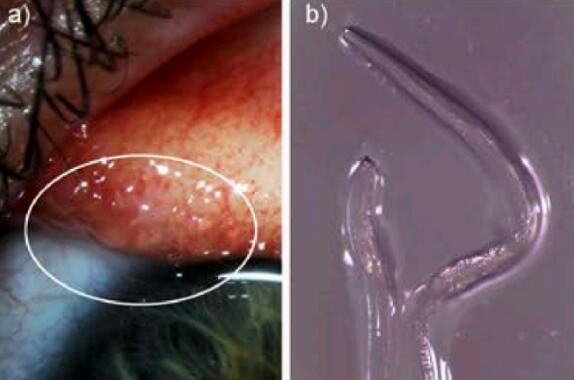 一女子骑马后眼睛里被发现感染有14条寄生虫