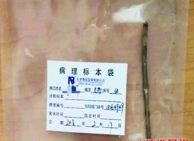 震惊！男子吞18厘米针致食管破裂 面色苍白疼到直不起腰惊呆医生