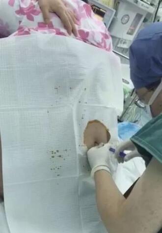 130斤涨至244斤！孕妇生产时脂肪厚得每缝1针都冒油