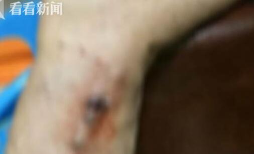 扎针放淤血险截肢 女子听信偏方治病 “扎针放血”致感染