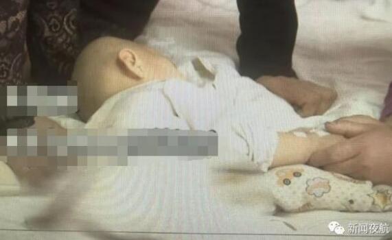 宝宝碰翻开水锅滚烫热水浇在身上 烫伤面积达25%