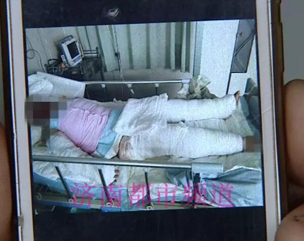 飞来横祸!济阳一女子洗澡时致特重度烧伤住进ICU 