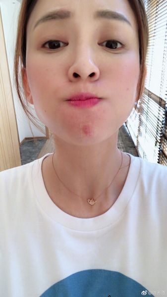 陈乔恩晒长痘自拍求救 逆龄的女明星也拿痘痘没辙?
