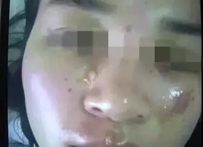 双皮奶爆炸女子遭“毁容” 这些东西切勿用微波炉加热