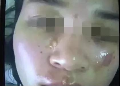 元凶亮了!双皮奶爆炸致女主毁容