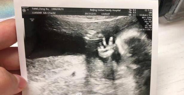 天生带喜感？曹云金宝宝B超照 看上去像摆出了V字手势