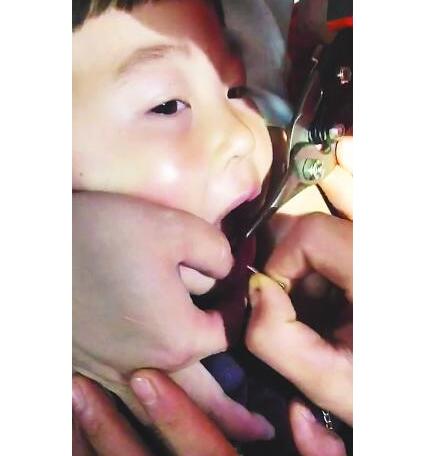 神操作!男童牙缝卡铁环 消防员用尖头钳伸男童