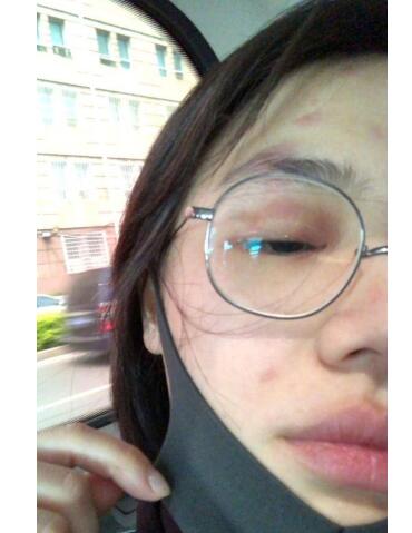 腰缠火龙?马思纯带状疱疹似毁容 素颜出镜眼皮