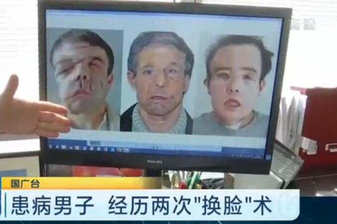 男子两次换脸手术 这台史无前例的手术持续近16小时