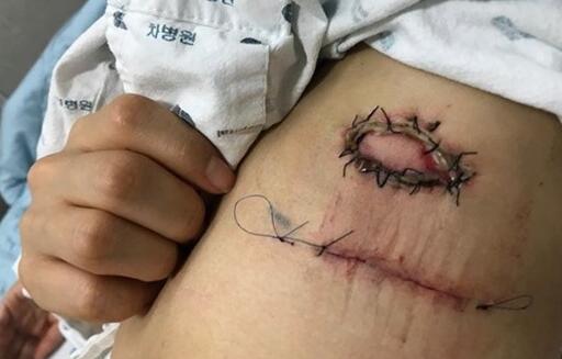 韩艺瑟医疗事故赔偿事宜正协商 巨大伤口外露网友惊呼太恐怖