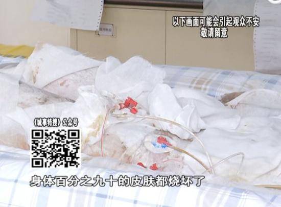 少女洗澡煤气爆炸：像个“火人”一样从洗手间冲出来 手术费上百万