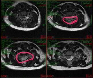 5岁男孩“脖子不舒服” 被爷爷带去按摩 回家一小时后瘫痪
