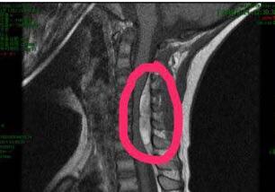 5岁男孩“脖子不舒服” 被爷爷带去按摩 回家一小时后瘫痪