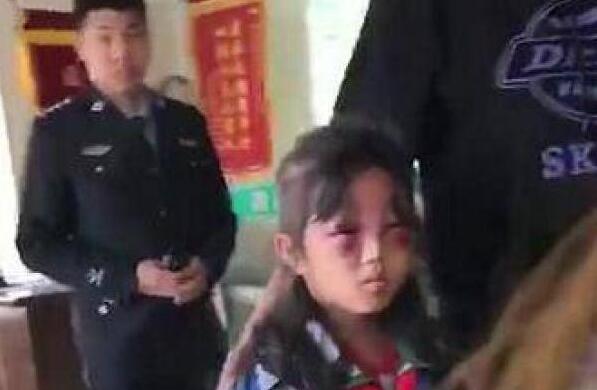 女孩遭继母打成“熊猫眼” 眼睛处肿胀如核桃让人心疼