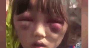 女孩遭继母打成“熊猫眼” 眼睛处肿胀如核桃让人心疼