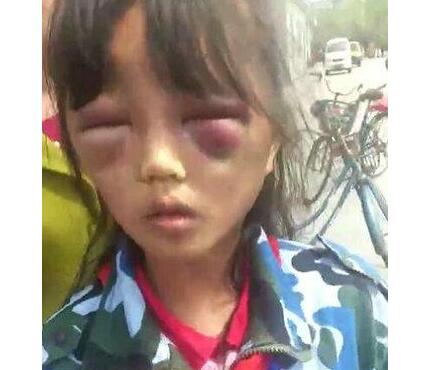 女孩遭继母打成“熊猫眼” 官方称已传唤调查打人者