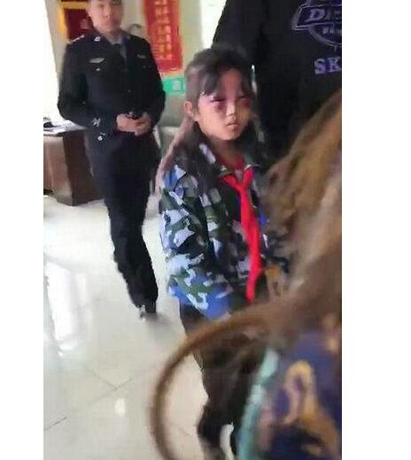 女孩遭继母打成“熊猫眼” 官方称已传唤调查打人者