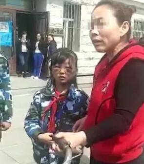 庆安9岁女孩被继母打成“熊猫眼”  继母涉嫌虐待被刑拘