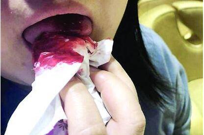 哈根达斯吃出玻璃女子舌头被割 担心玻璃碴进入肠胃