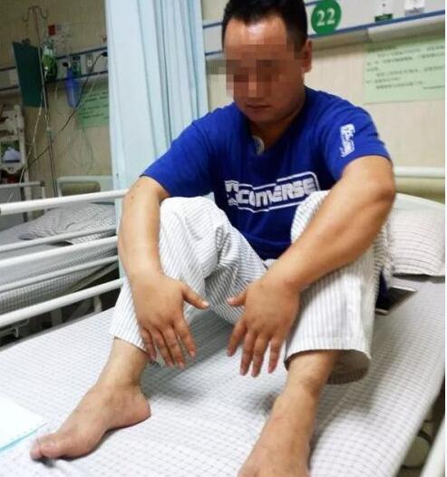 男子垂钓被蚂蚁咬伤致过敏性休克 红火蚁含剧毒被咬后严重可致心脏骤停
