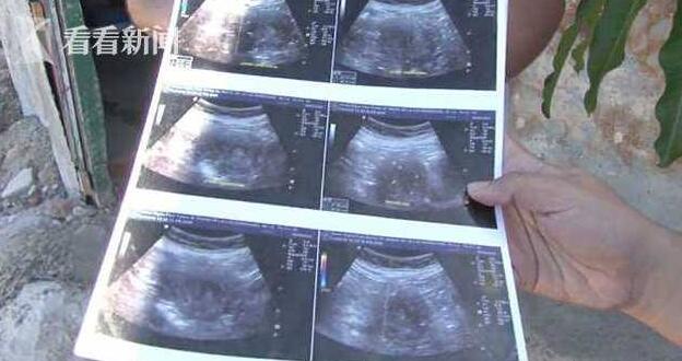 70岁当妈!全球最高龄产妇自称已经怀孕6个月 是个女孩