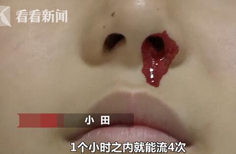 辍学了!冬天一学习就流鼻血 12岁男孩脑袋核磁共振没有问题